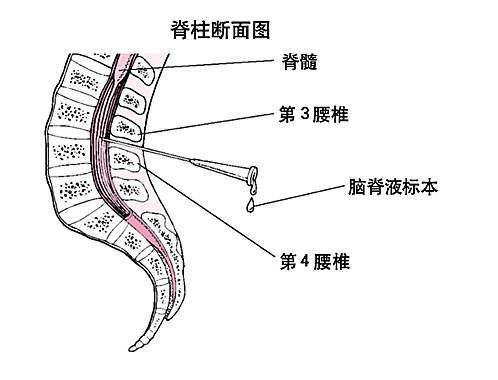 儿童做腰穿危险吗