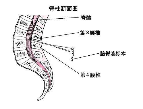 兒童做腰穿危險嗎