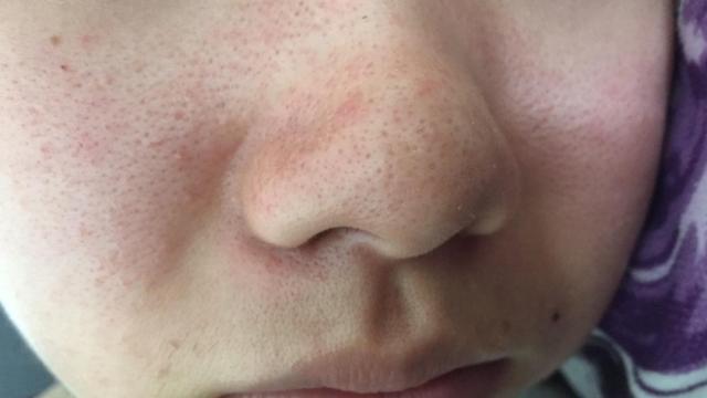 头部有这3个信号,表示肺部已被尼古丁所伤,吸烟的人多了解