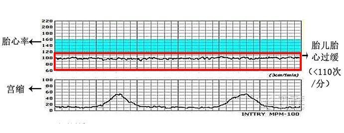胎心監護檢查攻略繞開胎心監護小陷阱告別胎監不合格