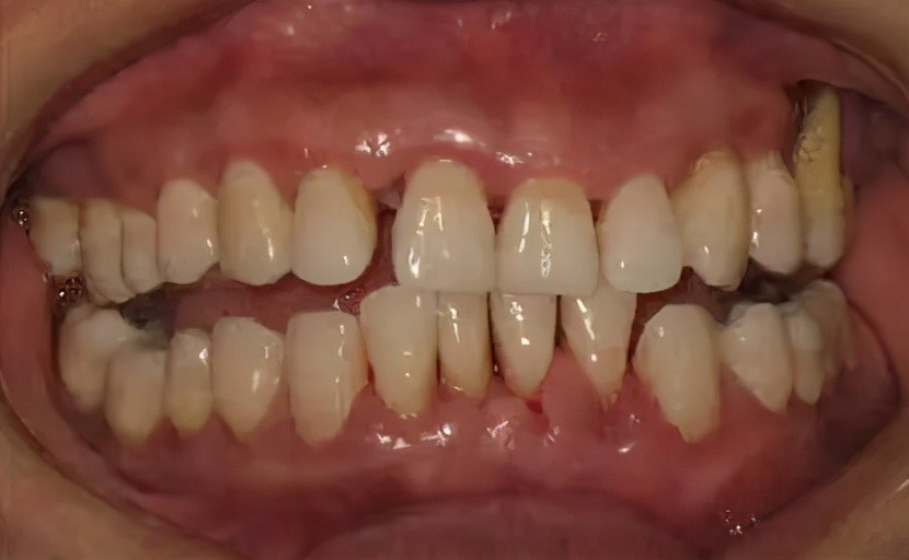 另外,不正确地使用牙签也会刺激局部的牙肉和牙槽骨,形成牙龈萎缩