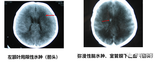 后冠狀切面:枕葉腦白質回聲瀰漫性增強腦室周圍白質軟化頭顱b超圖2 腦