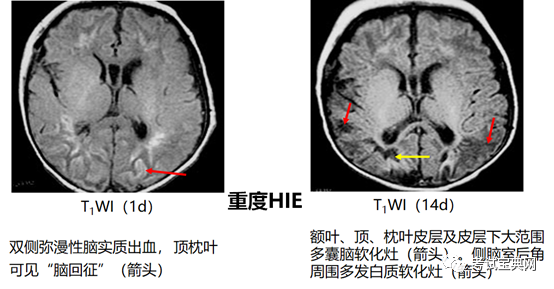 新生儿与新生儿疾病 新生儿缺氧缺血性脑病 腾讯新闻