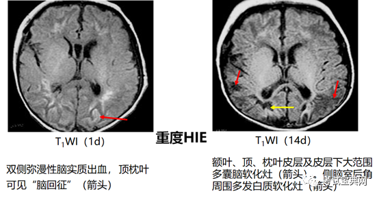 頭顱mri后冠狀切面:枕葉腦白質回聲瀰漫性增強腦室周圍白質軟化頭顱