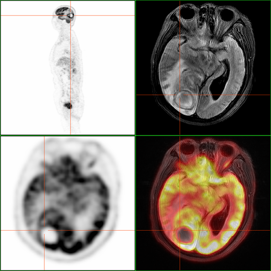 顶尖医疗丨pet-mr,让萌芽阶段的肿瘤无处可藏_腾讯新闻