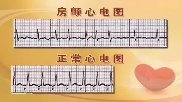 心室颤动心电图表现图片