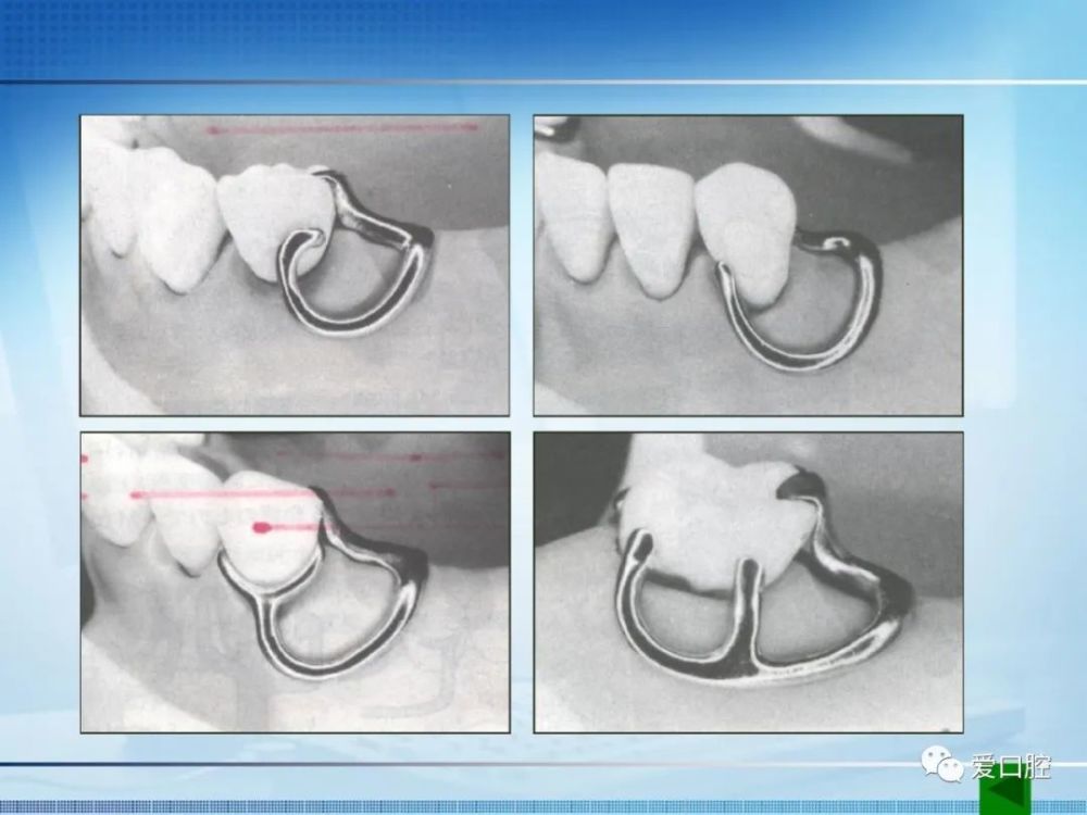 基託取模實拍可摘局部義齒固位力的調節方法分享可摘局部義齒設計的