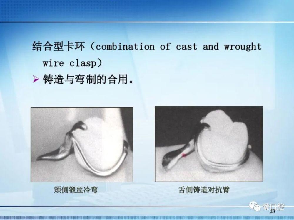 可摘局部義齒中卡環的種類