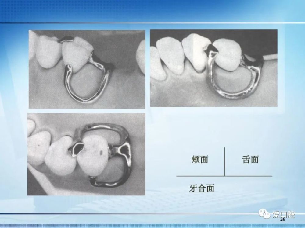 原則及要求可摘局部義齒鋪蠟,製作蠟堤實拍可摘局部義齒鈷鉻合金基託