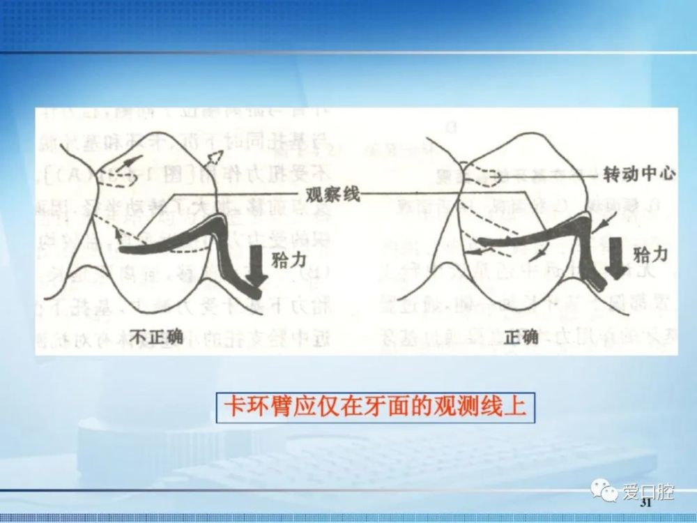 可摘局部義齒中卡環的種類