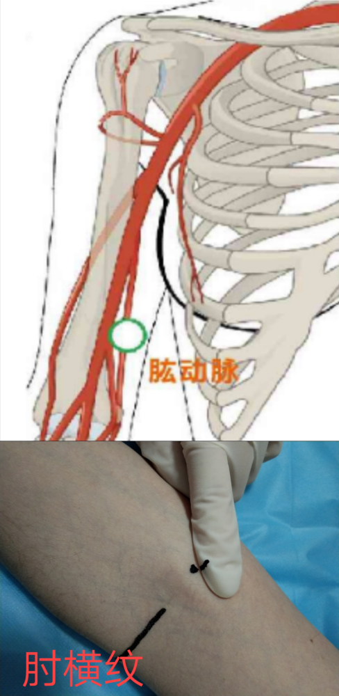 (3)股动脉腹股沟韧带中点下方 1 ~ 2 cm ,或耻骨结节于髂前上棘连线