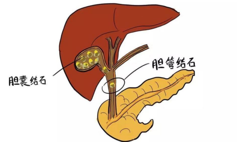 一旦當膽結石症狀足夠強烈時,疼痛感是在所難免的,而且膽結石發作時