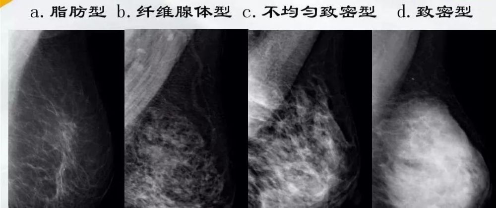 健康科普一文讀懂乳腺鉬靶