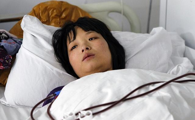 尿毒症晚期,肾几乎"报废"!导致尿毒症的3大习惯你占了几个?