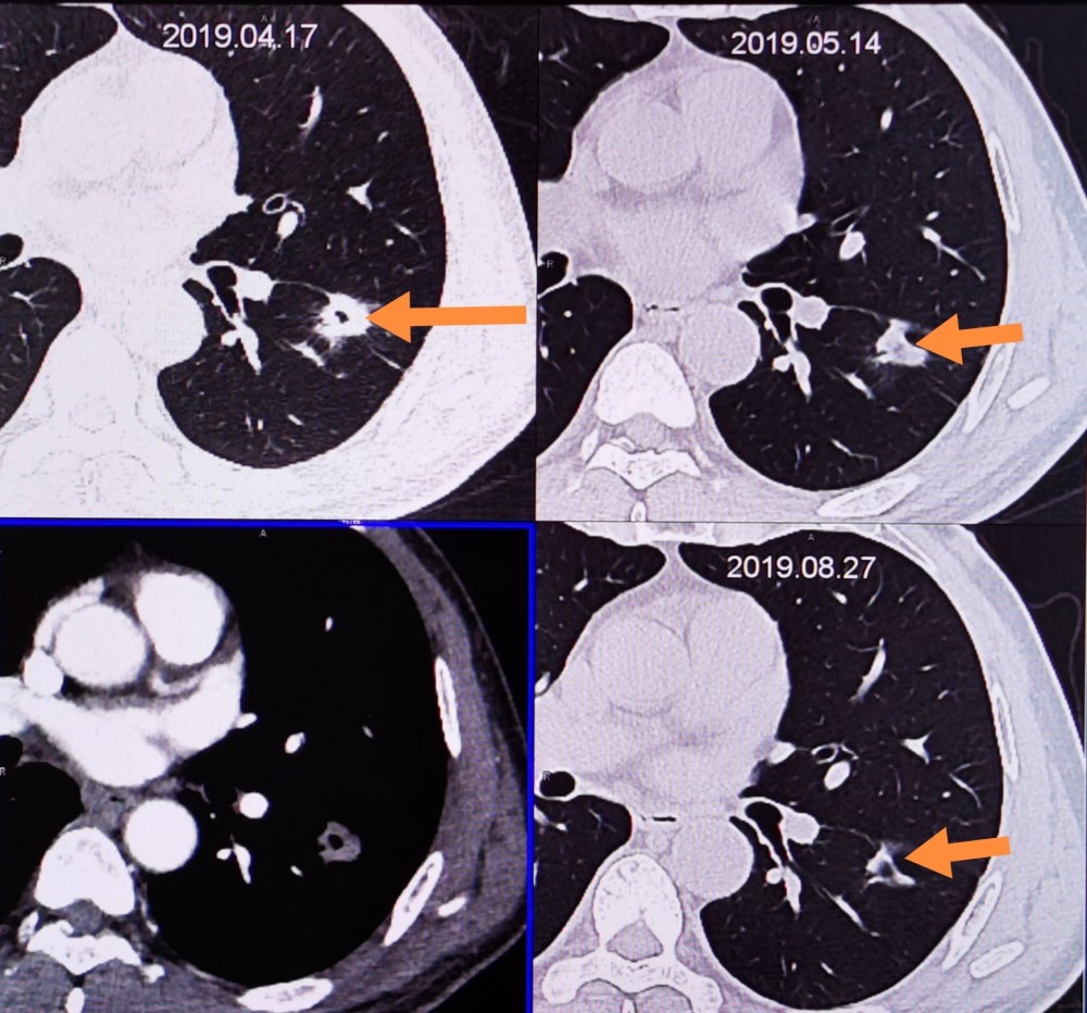 ct查出肺结节为什么不切等它长大吗