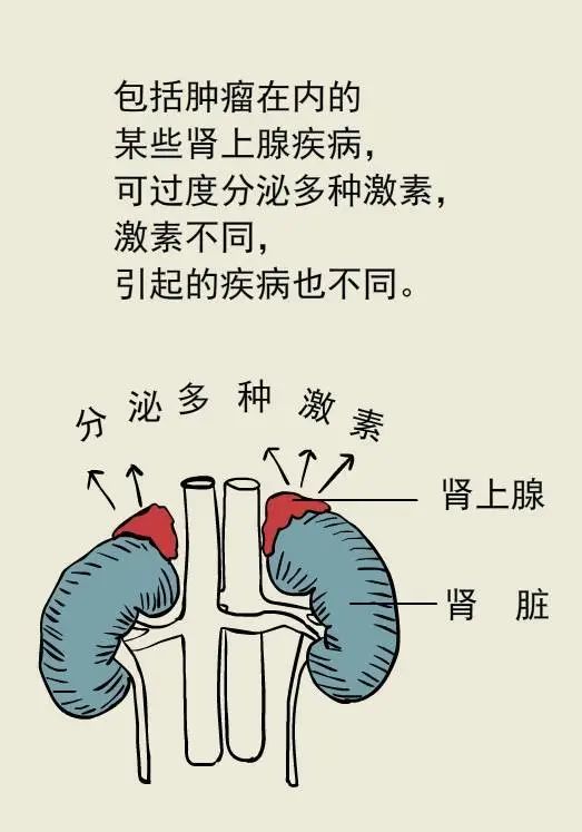 什麼腎上腺長了個東西還能與高血壓有關