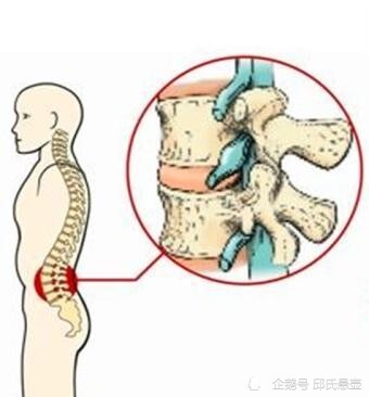 腰椎間盤突出為什麼容易發生在l4l5s1之間?邱氏懸壺