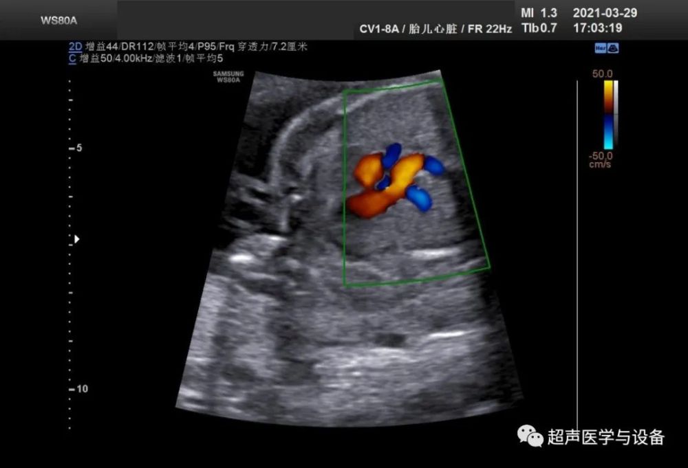 右位动脉导管超声提示:2,胎儿心脏主动脉弓及动脉导管走行于气管右侧