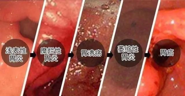 判断其轻重1,轻度浅表性胃炎如果体检发现浅表性胃炎,没有任何症状