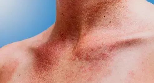 肤康科普夏季来临紫外线导致的这种皮肤病要小心