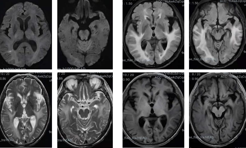 进行核上性麻痹亚急性联合变性灰质异位症丨3分钟读片6126期