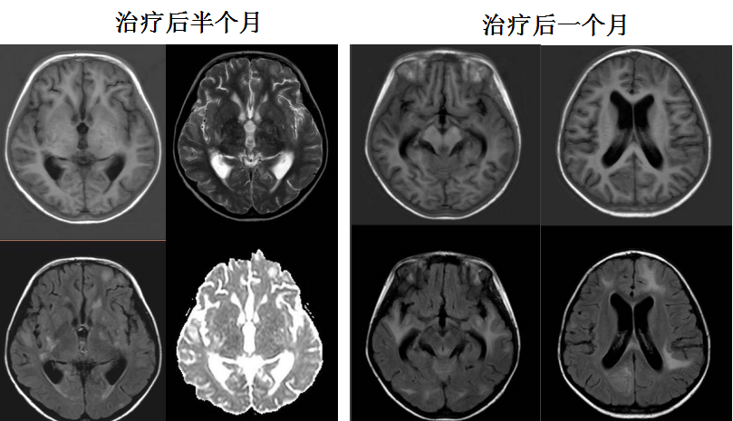 进行核上性麻痹亚急性联合变性灰质异位症丨3分钟读片6126期