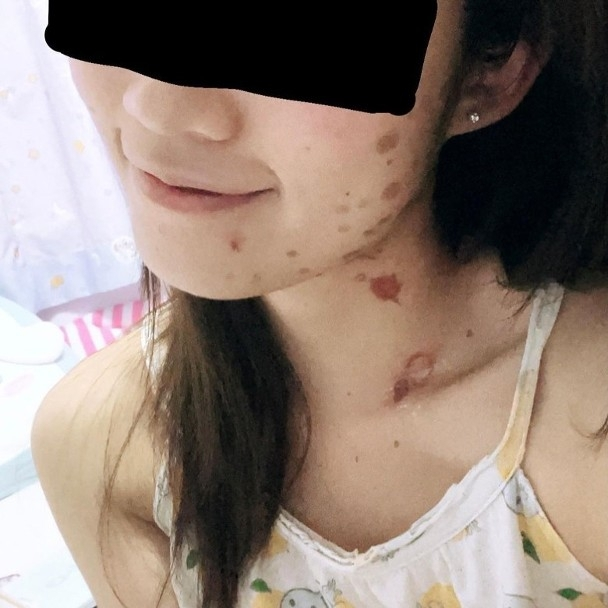 近日,tvb美女主播黄凯怡在社交平台上晒出自己被烧伤的照片,伤口遍布