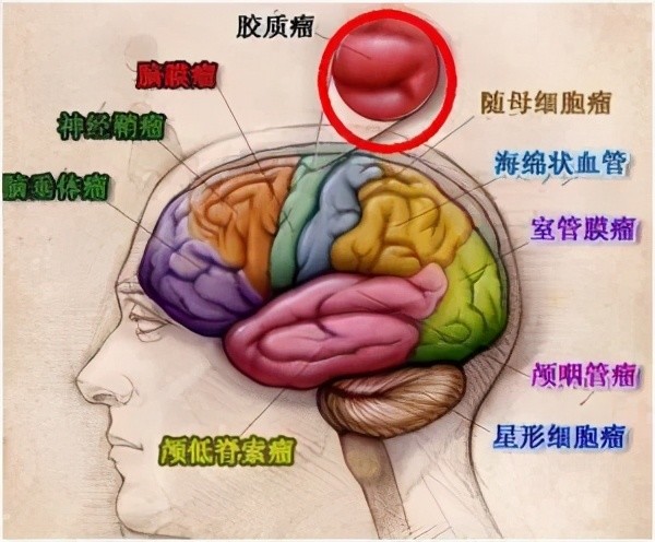 夺走拜登长子生命的肿瘤脑胶质瘤知多少
