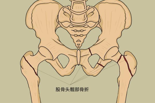 24歲女孩髖部疼,查出股骨頭壞死,或因早先服用了三個月激素