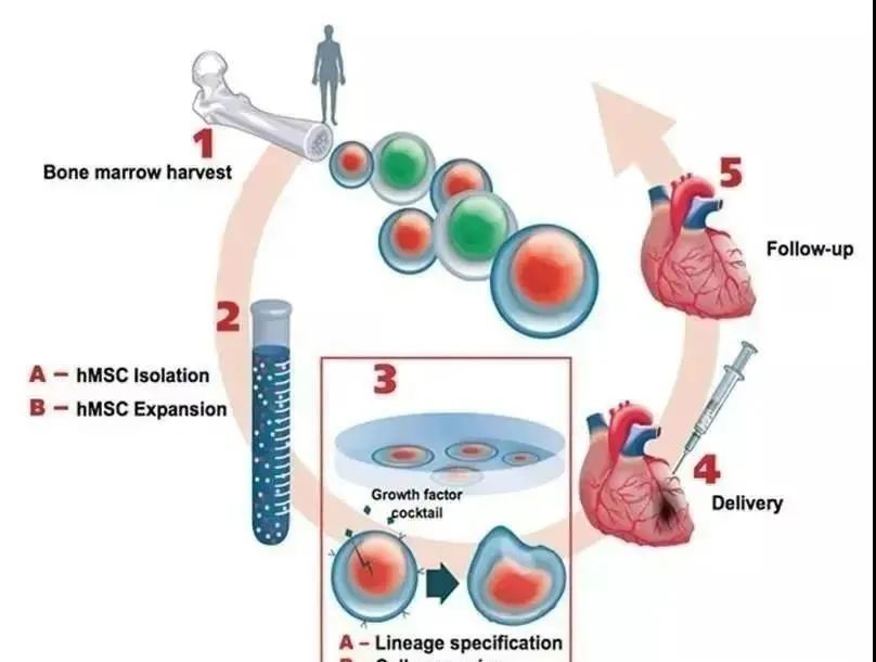 干细胞疗法|给心衰患者一线生机!