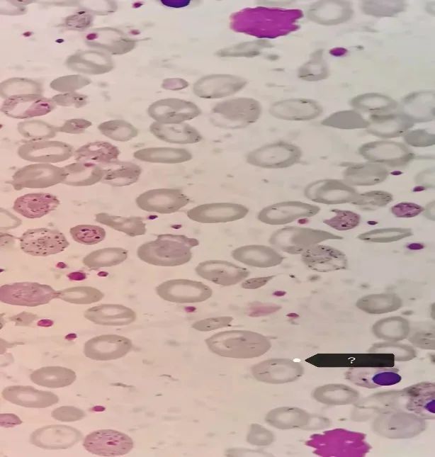 变形珠蛋白小体即heinzbody:是g6pd缺乏患者血样中加入乙酰苯肼于37