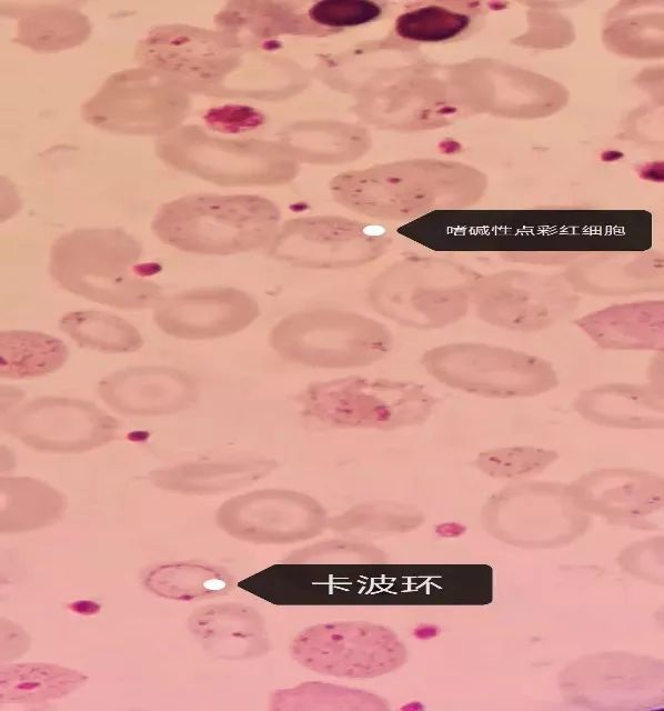 变形珠蛋白小体即heinzbody:是g6pd缺乏患者血样中加入乙酰苯肼于37