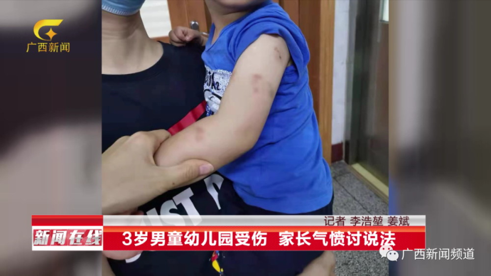 3岁男童幼儿园受伤家长气愤讨说法