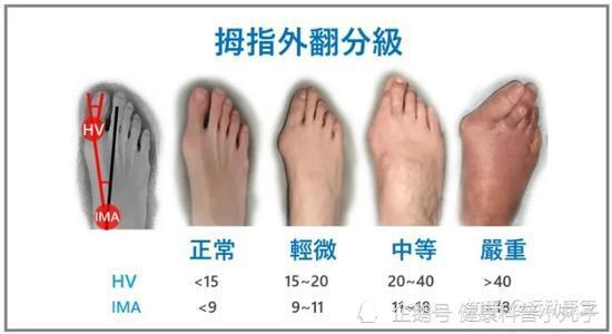 成都保髋拇外翻矫形中心提问什么是拇外翻不要等严重了才知道