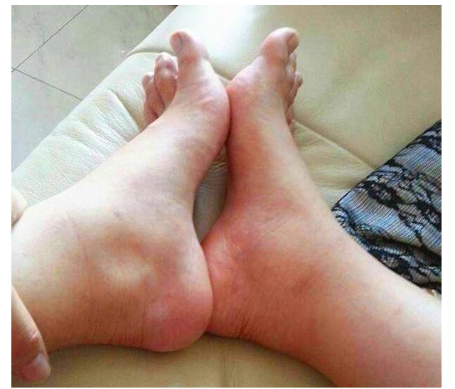 尿酸偏高的人身体可能会有3种表现不妨自查一下