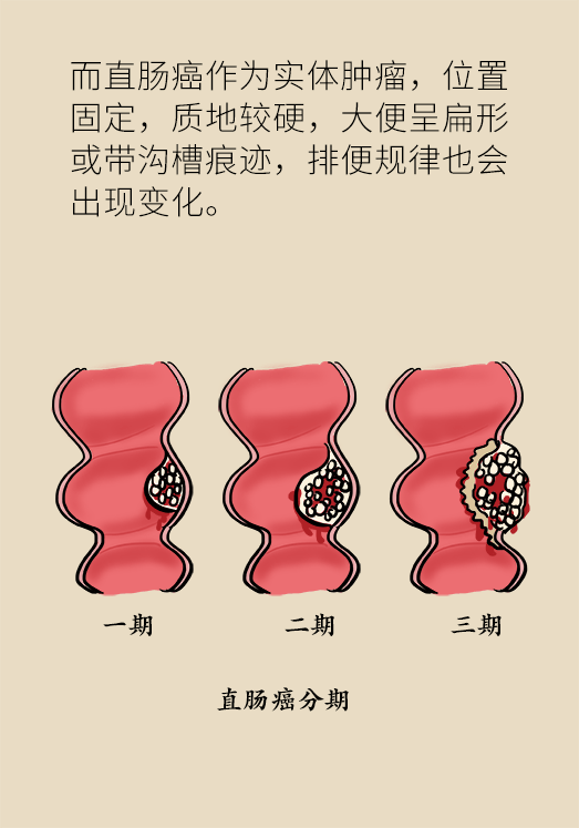 直肠癌和痔疮有什么不同?医生给出正确答案,不妨了解一下