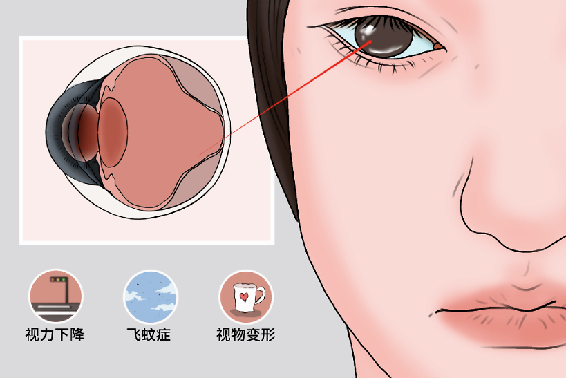 医生:视网膜脱离"24小时内"尽快就医_腾讯新闻