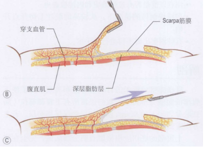 产后腰腹松弛克星get腹壁成形术