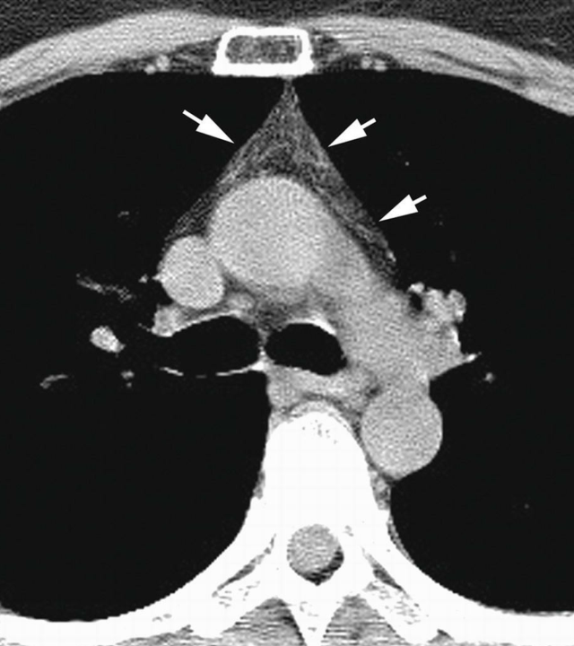 25 g,青春期生长到顶峰,约 35~50 g,青春期后开始萎缩退化,胸腺逐渐被