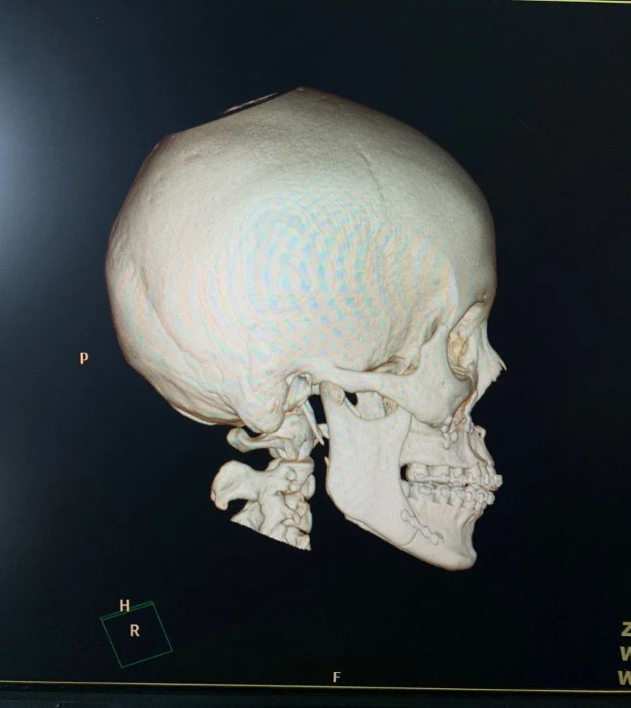 术后颅骨三维重建,咬合已经基本正常,能看到固定骨头的钛钉丨作者供图