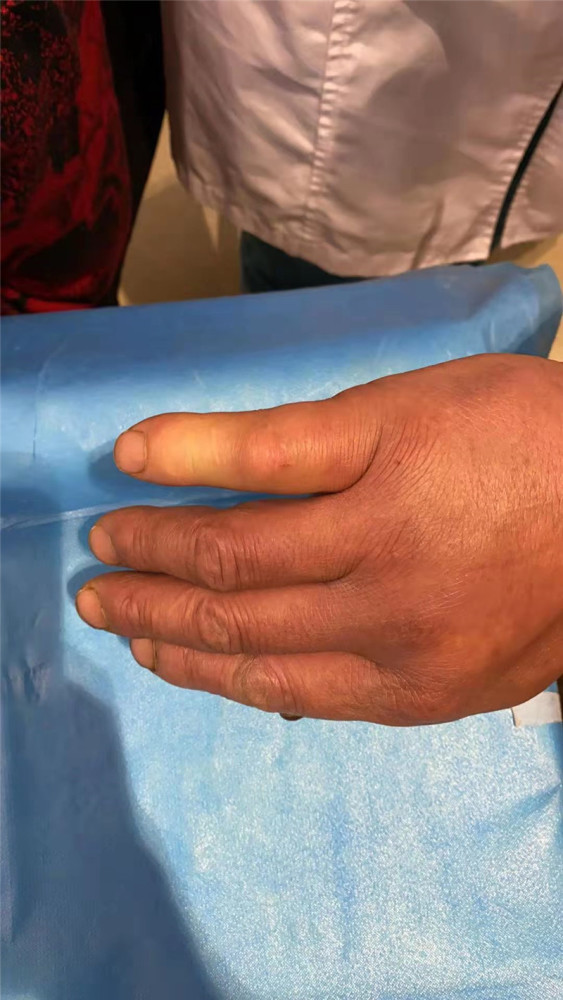 注意天气渐热蛇出没昆明一男子被竹叶青咬伤