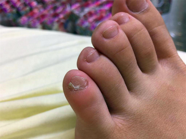小脚趾甲裂成两瓣的人到底什么来历是纯种汉族人说出来你别不信