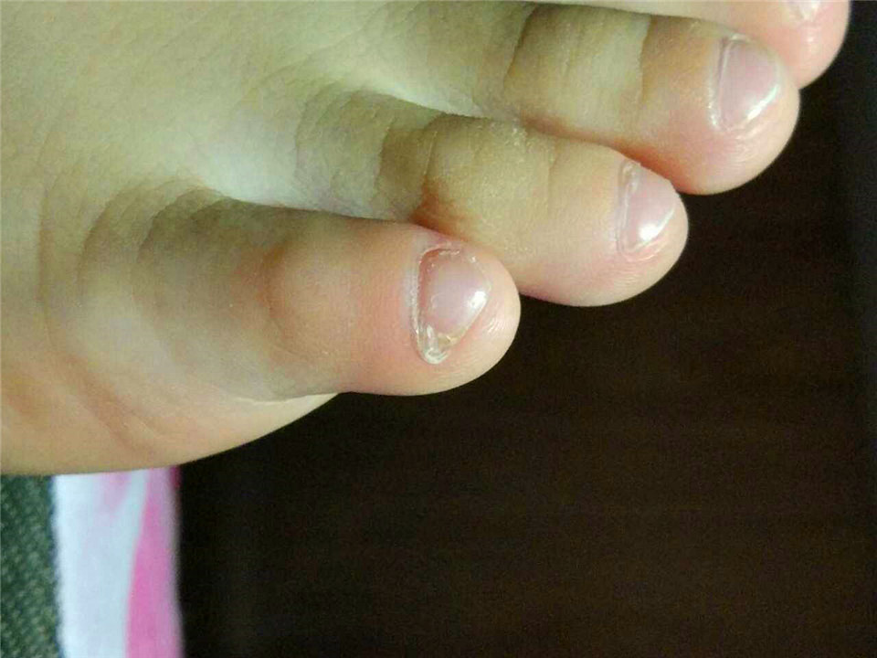 小脚趾甲裂成两瓣的人到底什么来历是纯种汉族人