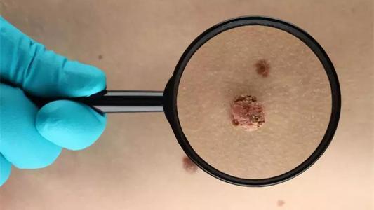 hpv|宫颈癌|夫妻|性病|人乳头状瘤病毒