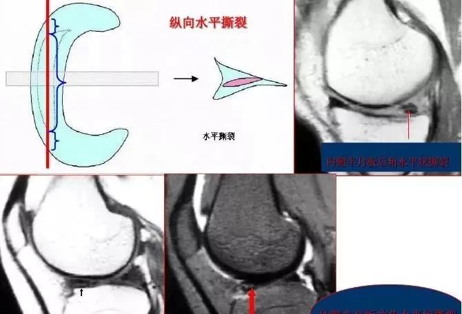 膝关节多种损伤mri表现合集 腾讯新闻
