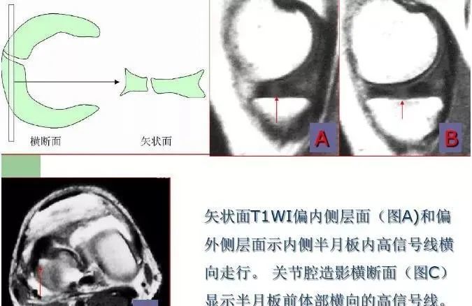 膝关节多种损伤mri表现合集 腾讯新闻