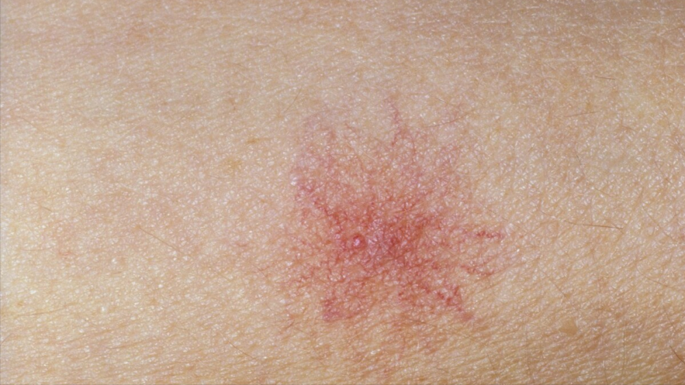 的排毒功能,导致血液循环不畅,血管出现扩张,皮肤上就会突然出现红痣