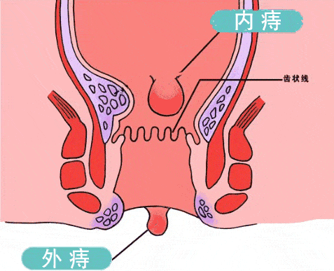 很多人以为长在肛门外的是外痔,肛门内的是内痔,这种理解是错误的.