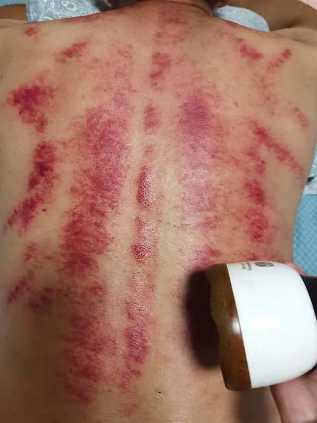 刮痧痛不痛,关键是看你"通不通"