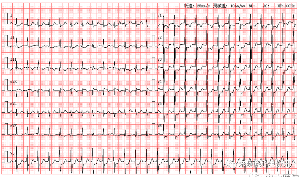 每日读图第1375期阵发性室上性心动过速